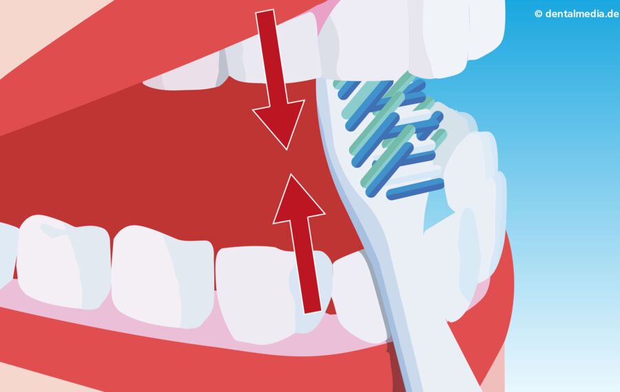 Putzen der Zahninnenflächen